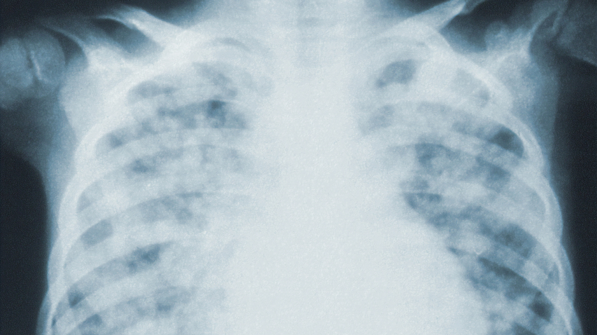 X-ray image of a human chest showing the ribs and lung area.